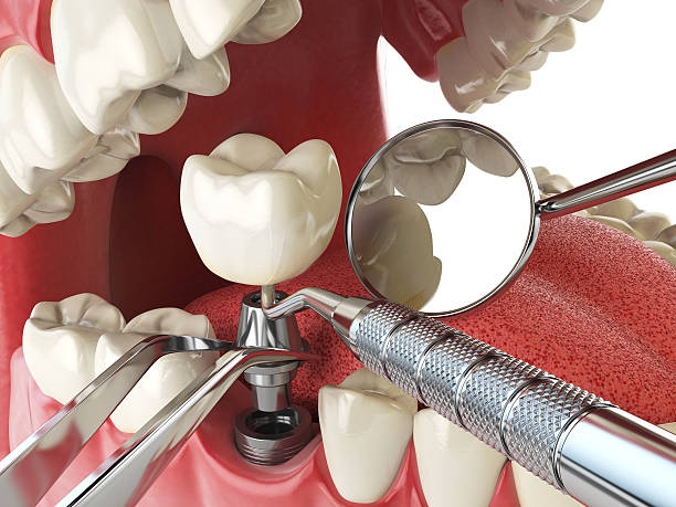 Best Emergency Tooth Extraction in East Merrimack, NH